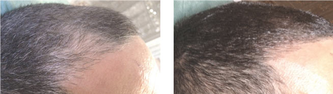 alopecia-localizada