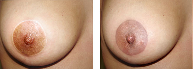 Areolas mamarias